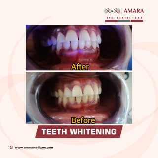 Before and after picture of Teeth whitened by AMARA MEDICARE LAGOS