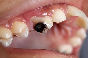 Image of tooth decay